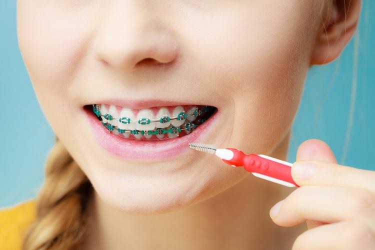 Are Interdental Brushes Better Than Floss?